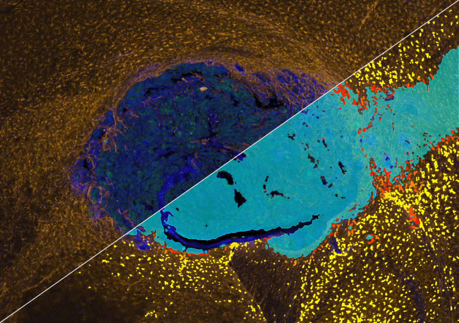 Glioblastoma PRE-POST_triangle